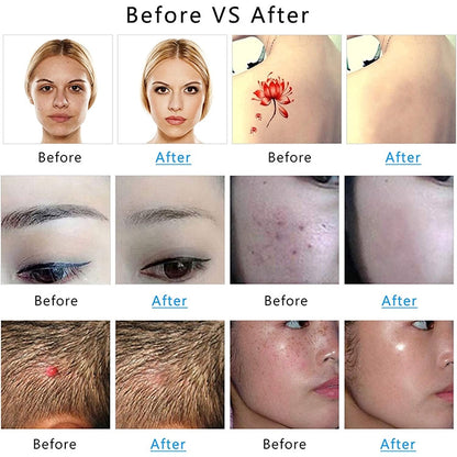 AA-A401 Small Freckle and Mole Removal Pen Tattoo and Eyebrow Removal Beauty Instrument, Red Light Plug-in, Blu-ray Plug-in, Red Light Battery, Blu-ray Battery