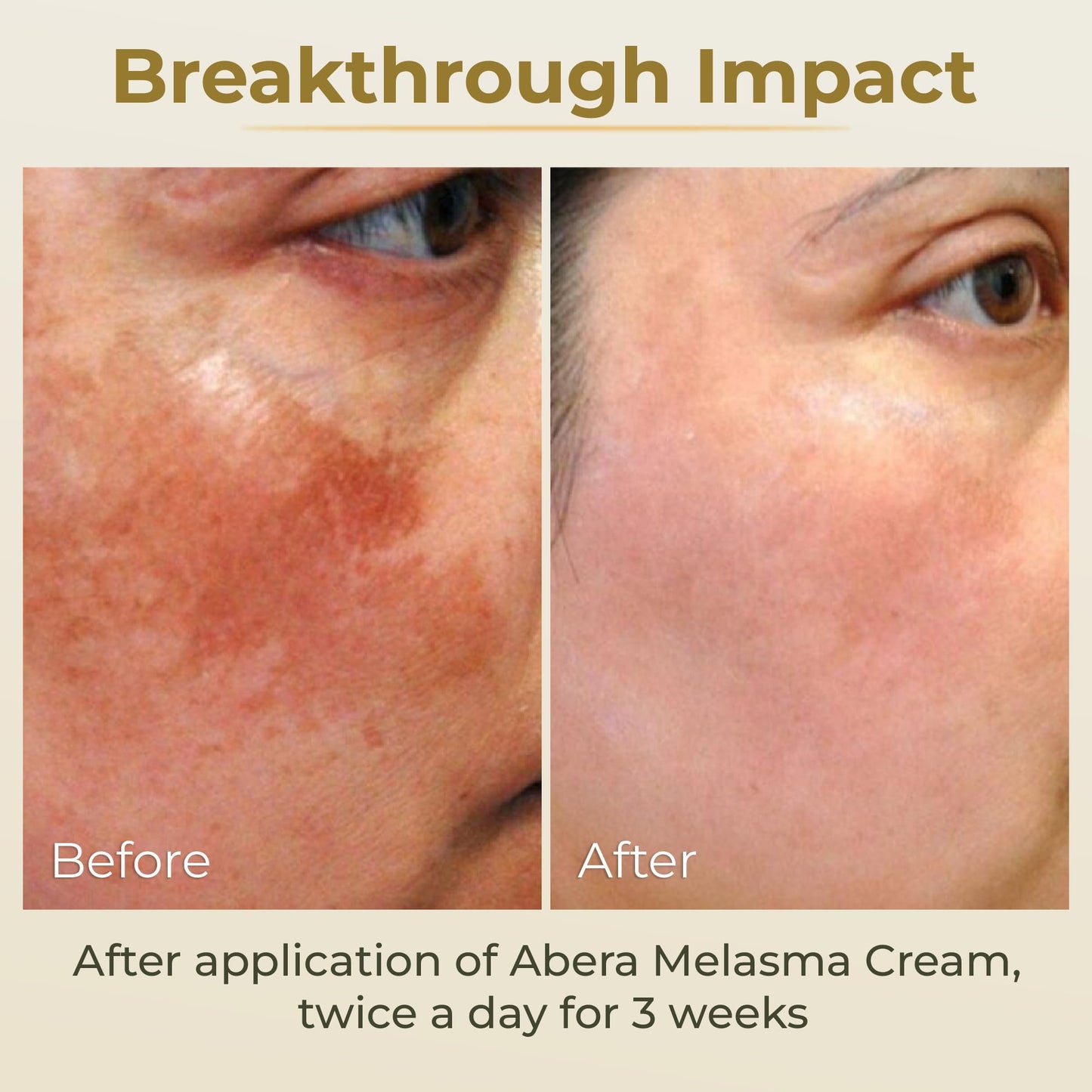 ABERA Melasma Cream - Dark Spot Corrector (0.7 oz) for Freckles, Sun Spots & Melasma