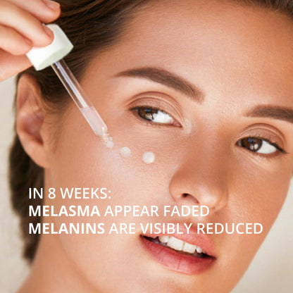 ABERA Melasma Serum Plus – Melasma Treatment for Face, Dark Spot Remover, All Skin Tones (1 FL OZ)