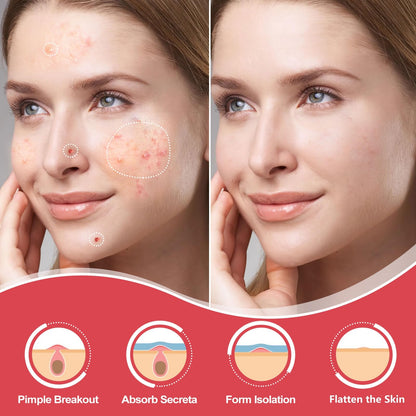 AcneGo 432 Counts Pimple Patches – Invisible Hydrocolloid Patches for All Skin Types