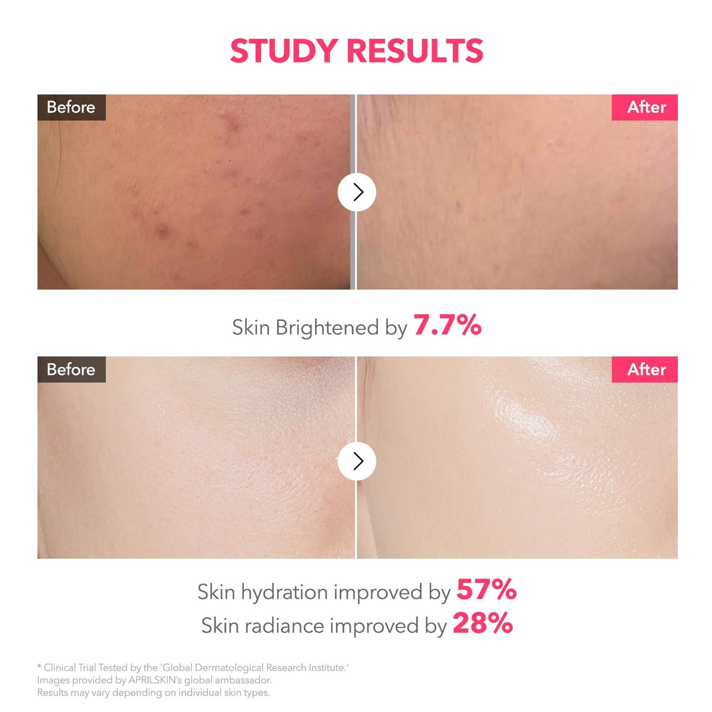 APRILSKIN TXA Pink Capsule Gel Mask | Overnight Glow with 99% TXA for Uneven Tone, Hydration & Radiance
