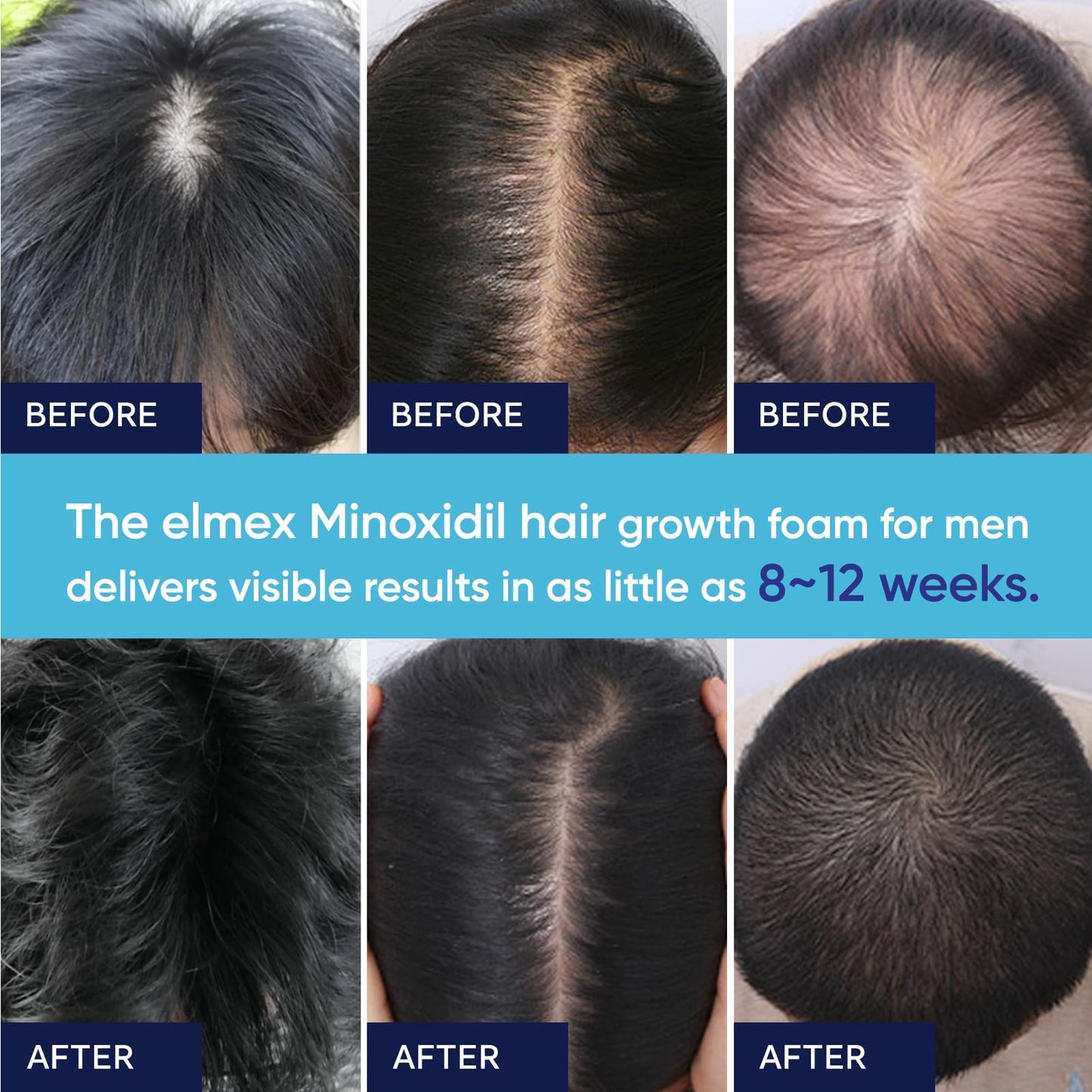 Artimore 5% Minoxidil Foam for Hair Growth – Men & Women, 12 oz