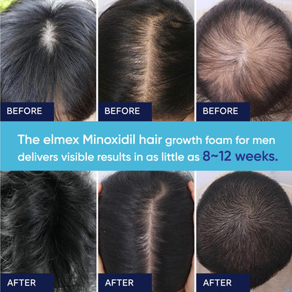 Artimore 5% Minoxidil Foam for Hair Growth – For Men & Women (2 oz)
