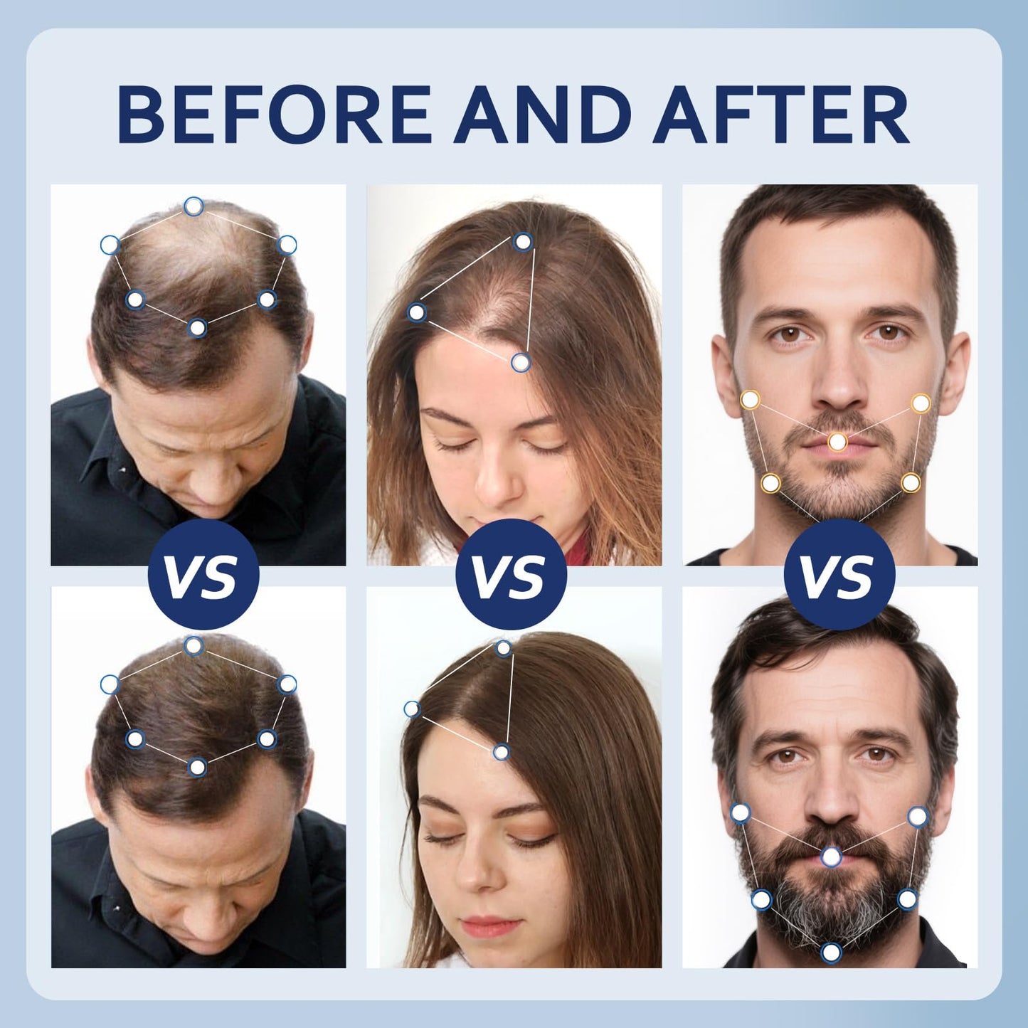 Artimore 5% Minoxidil Hair Growth Serum for Men & Women – Extra Strength, 4 Fl Oz x 2 Bottles