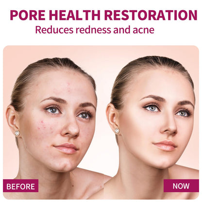 Azelaic Acid Serum for Balanced Skin Tone & Clear Pores – Acne & Redness Relief, 20g