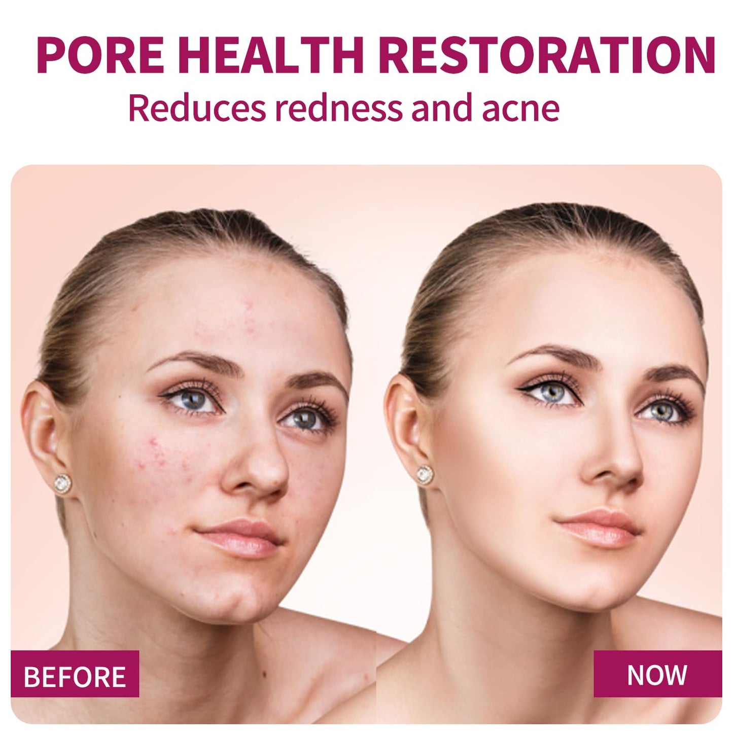 Azelaic Acid Serum for Face – Balance Skin Tone & Purify Pores, Acne Relief, Premium Skin Care, 20g