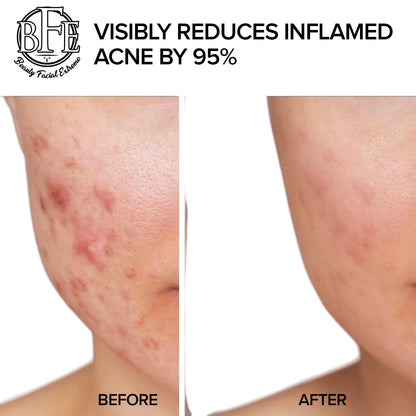 Beauty Facial Extreme Acne Treatment Pads – Clear Pimples, Oily Skin & Pores