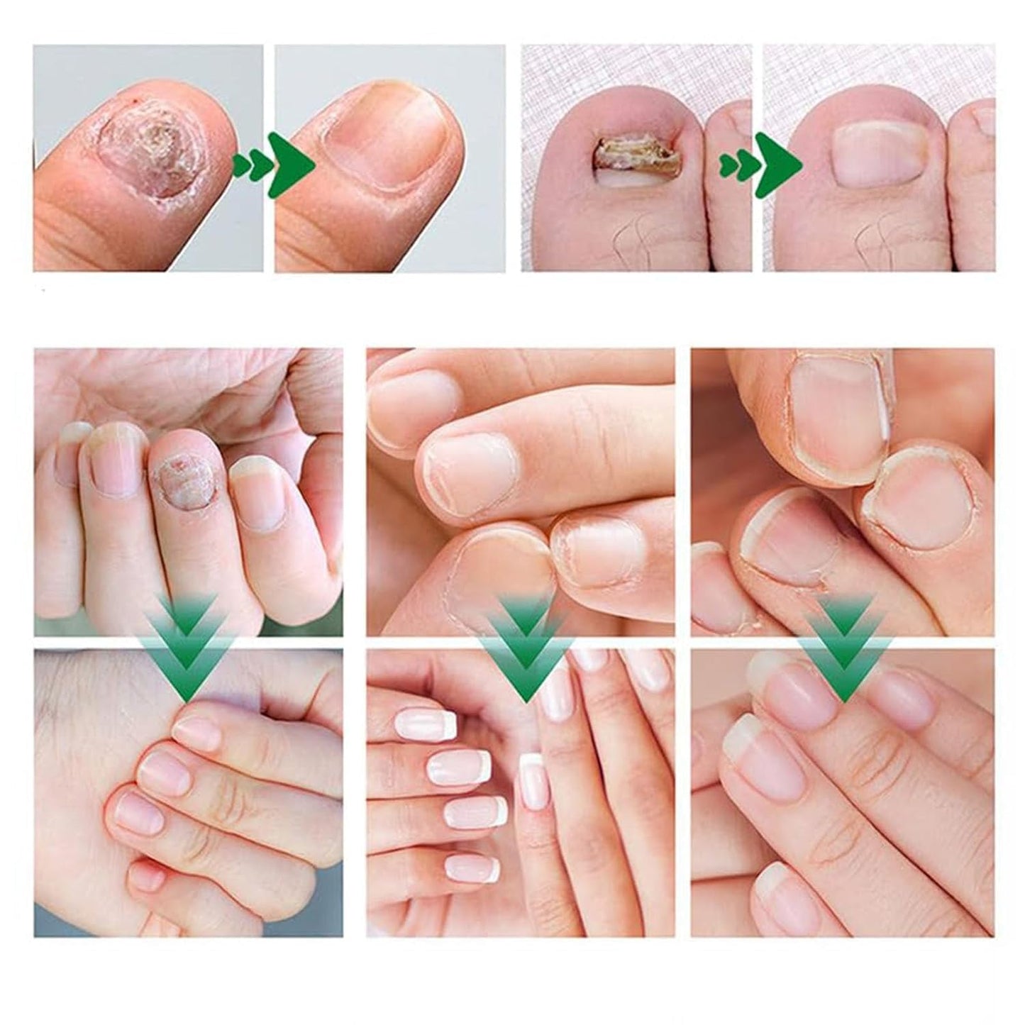 Beuifvo Nail Fungus Treatment Gel – Natural Nail Repair & Growth Serum (2pcs)