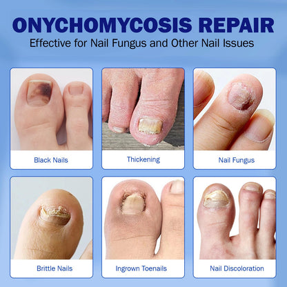 BFGCKJ Fungal Nail Patches for Toenails – 42 Count, 8-Hour Overnight Adhesion