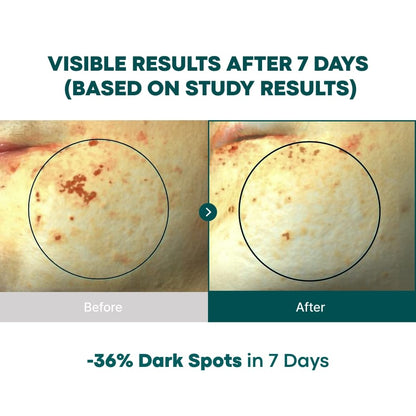 BONCEPT Vita C Capsule Double Shot Ampoule Kit – Korean Serum for Dark Spots & Even Skin Tone