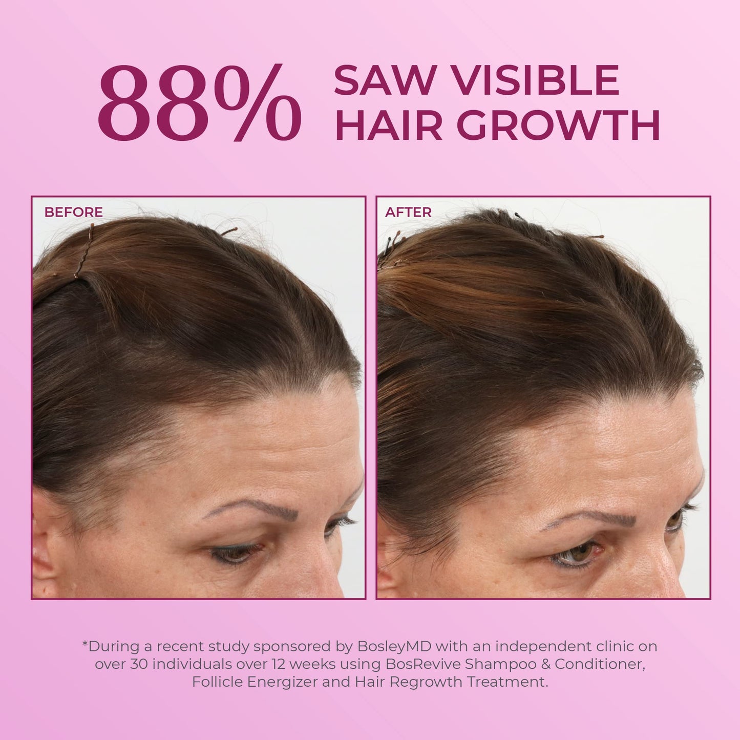 BosleyMD Minoxidil Woman Spray – 2% Hair Regrowth Treatment for Women | No-Mess Sprayer, 2-Month Supply