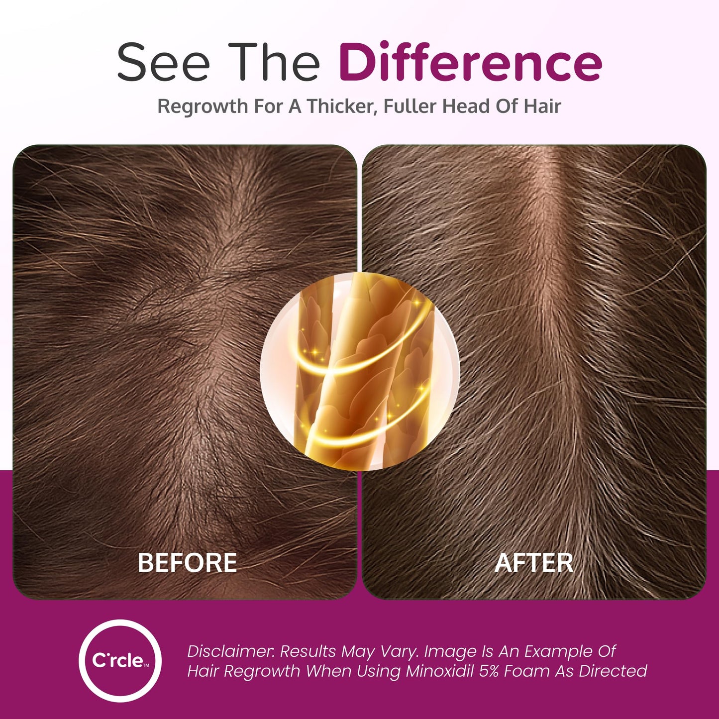 C'rcle 5% Minoxidil Foam for Women — Eight-Month Crown Hair Regrowth