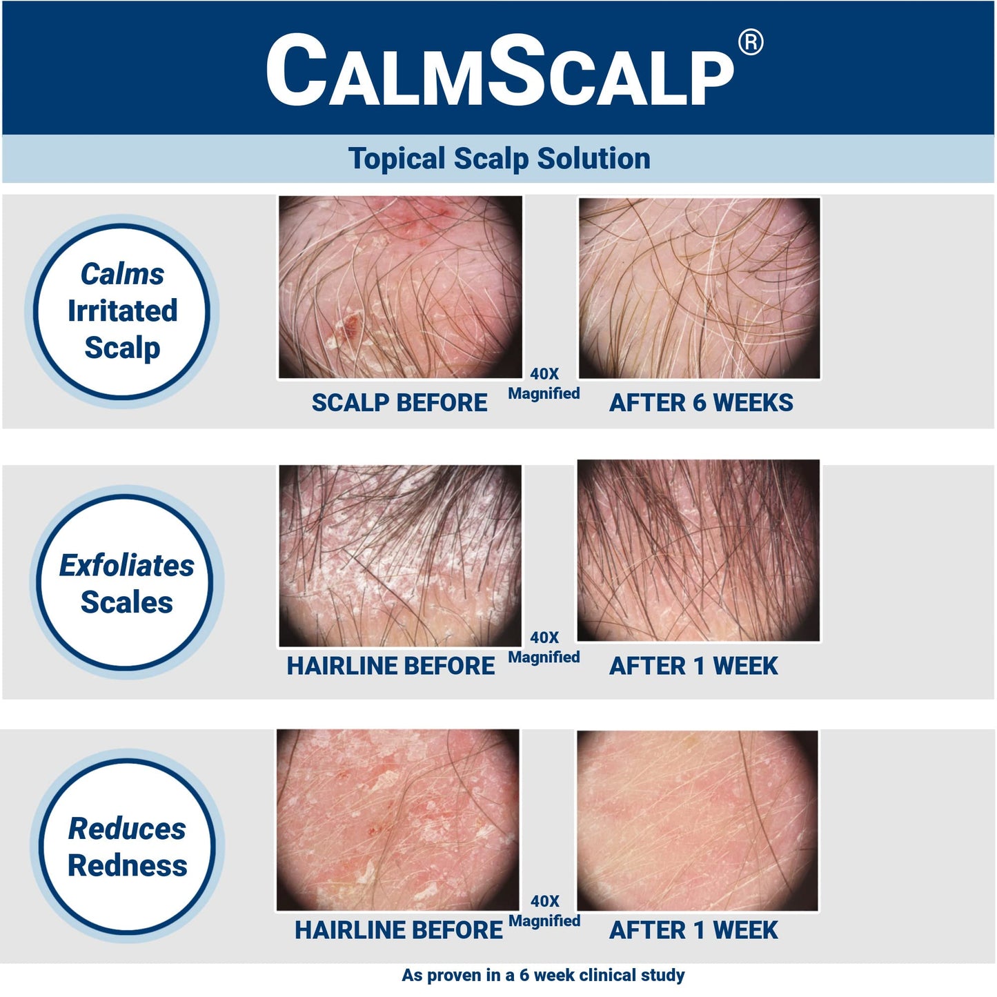 CalmScalp Scalp Treatment - Itch Relief, Flake Reduction, Made in USA - 4 oz
