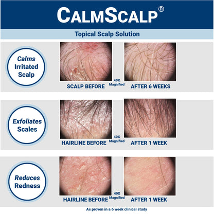 CalmScalp Scalp Treatment - Itch Relief, Flake Reduction, Made in USA - 4 oz