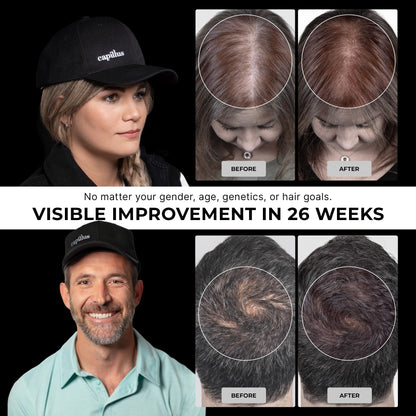 Capillus Pro S2 Red Light Cap for Hair Regrowth | 308 Laser LLLT Hat