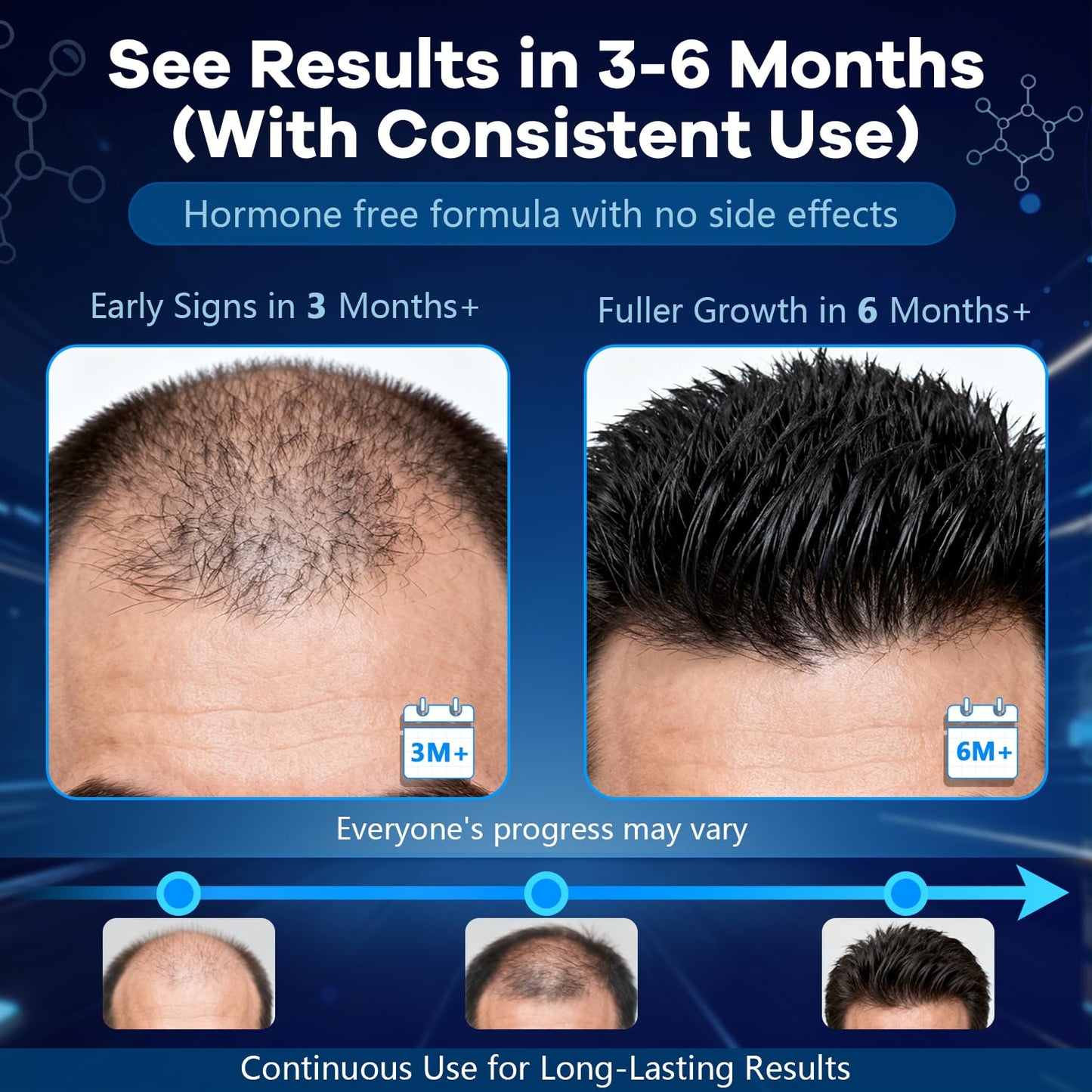 CARENICE 5% Minoxidil Foam for Men with Biotin – Unscented, 4.22 oz (2 Months Supply)