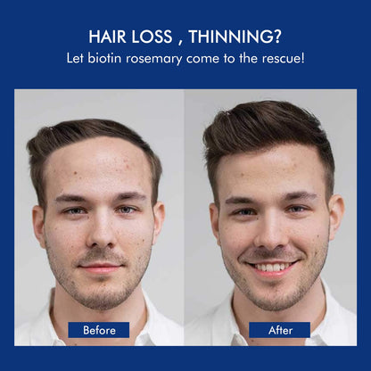 Ceson&Cesun Rosemary & Biotin Hair Growth Shampoo – Thicker, Stronger Hair for Men & Women