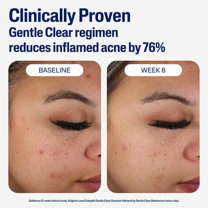 Cetaphil Mattifying Acne Moisturizer with 0.5% Salicylic Acid – Gentle Hydration for Sensitive, Acne-Prone Skin | 3oz