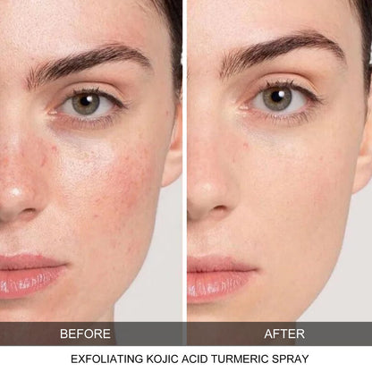 CHZHEN Keratin Care Kojic Acid Turmeric Spray – Gentle Exfoliating Brightening for Face & Body