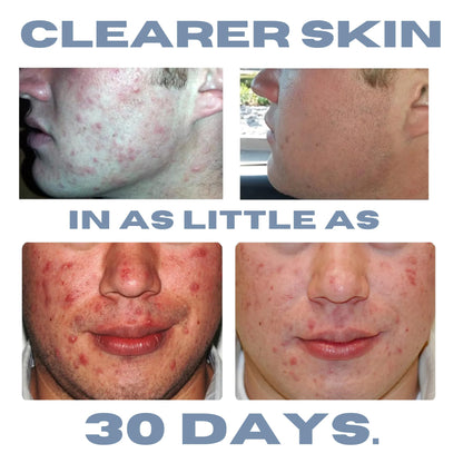 Clearogen Sensitive Skin Sulfur Acne Lotion - Acne Treatment 1.8 oz