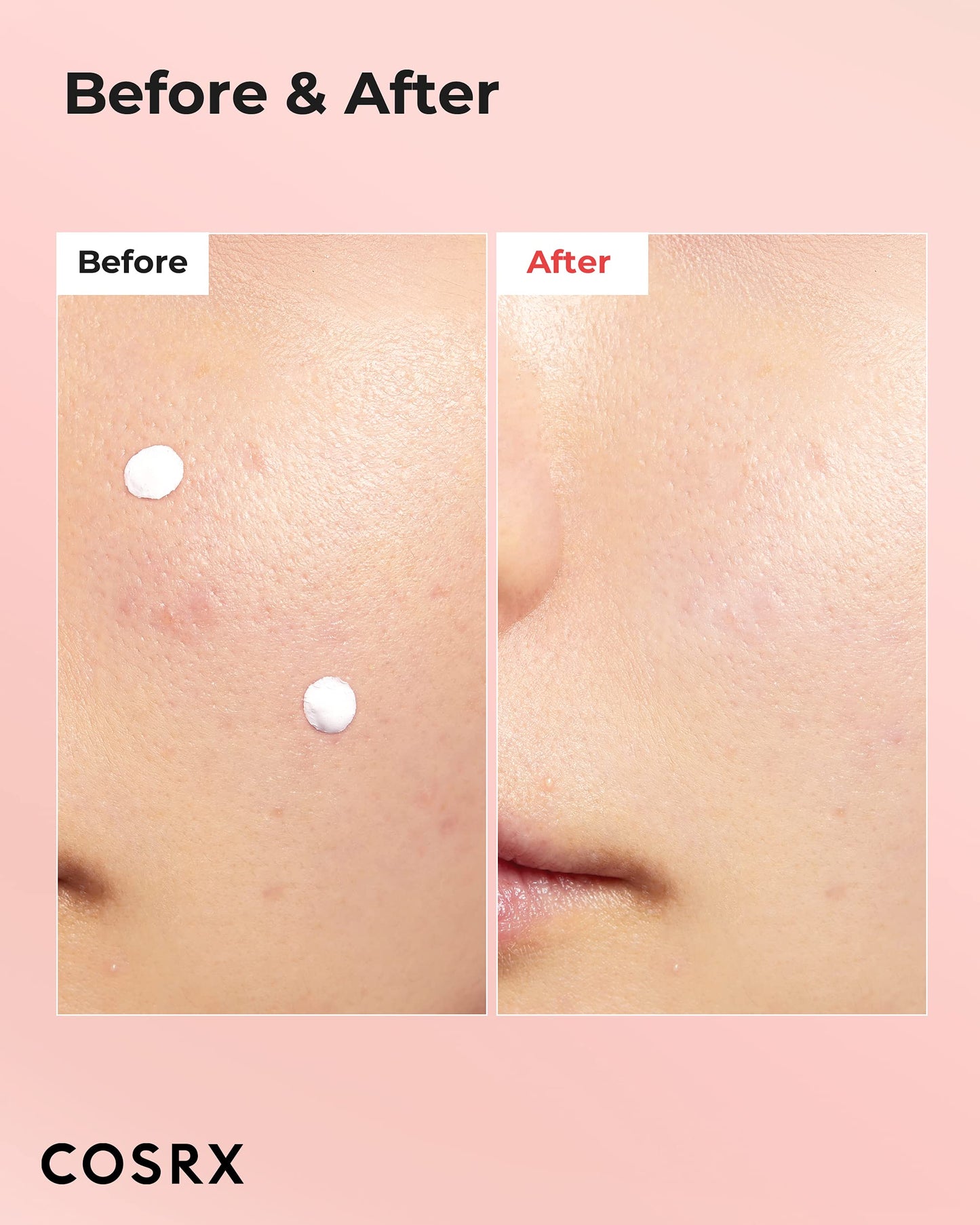 COSRX Acne Blemish Spot Drying Lotion 1.01 fl oz / 30 ml – Targeted Spot Treatment for Blemishes