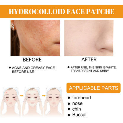 Coweroay 20PCS Hydrocolloid Acne Patches – Full-Face Spot Coverage