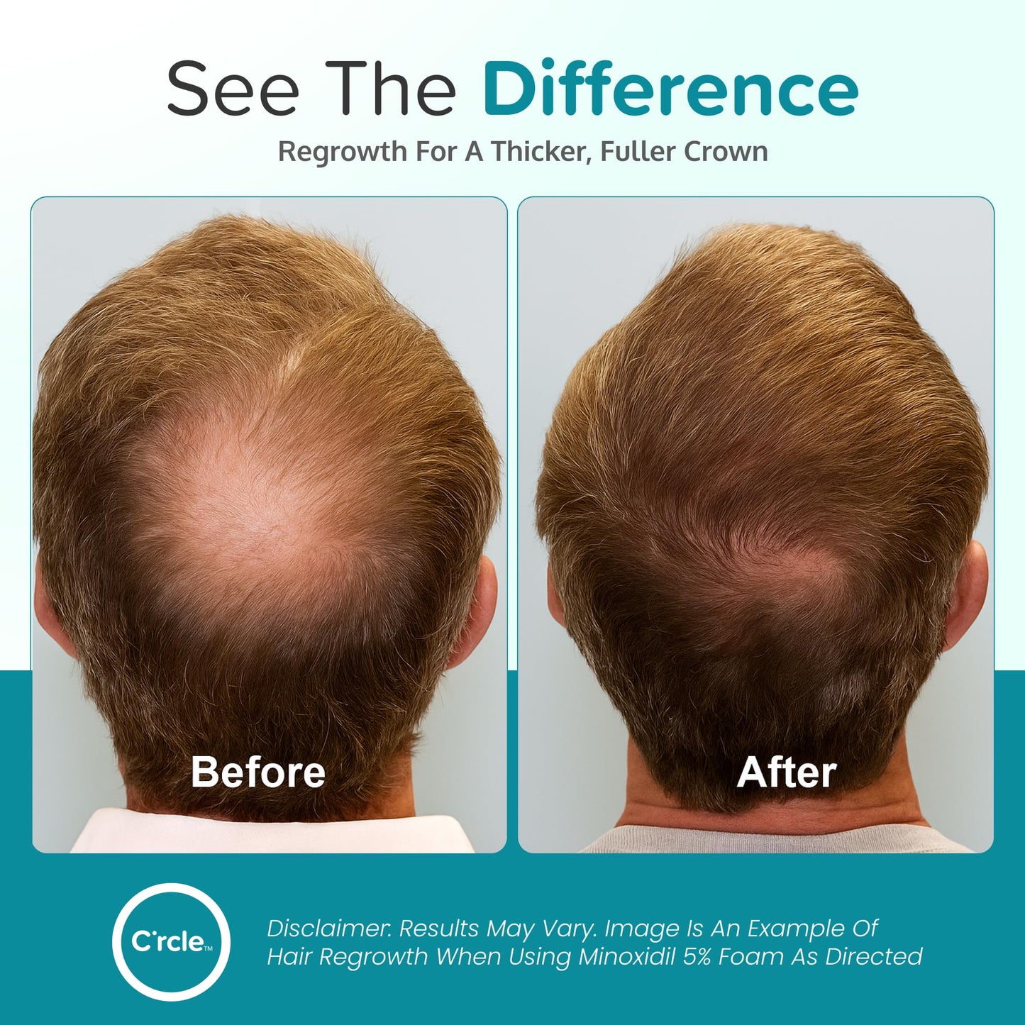 C'rcle Minoxidil for Men Foam 5% - Unscented, 6-Month Supply