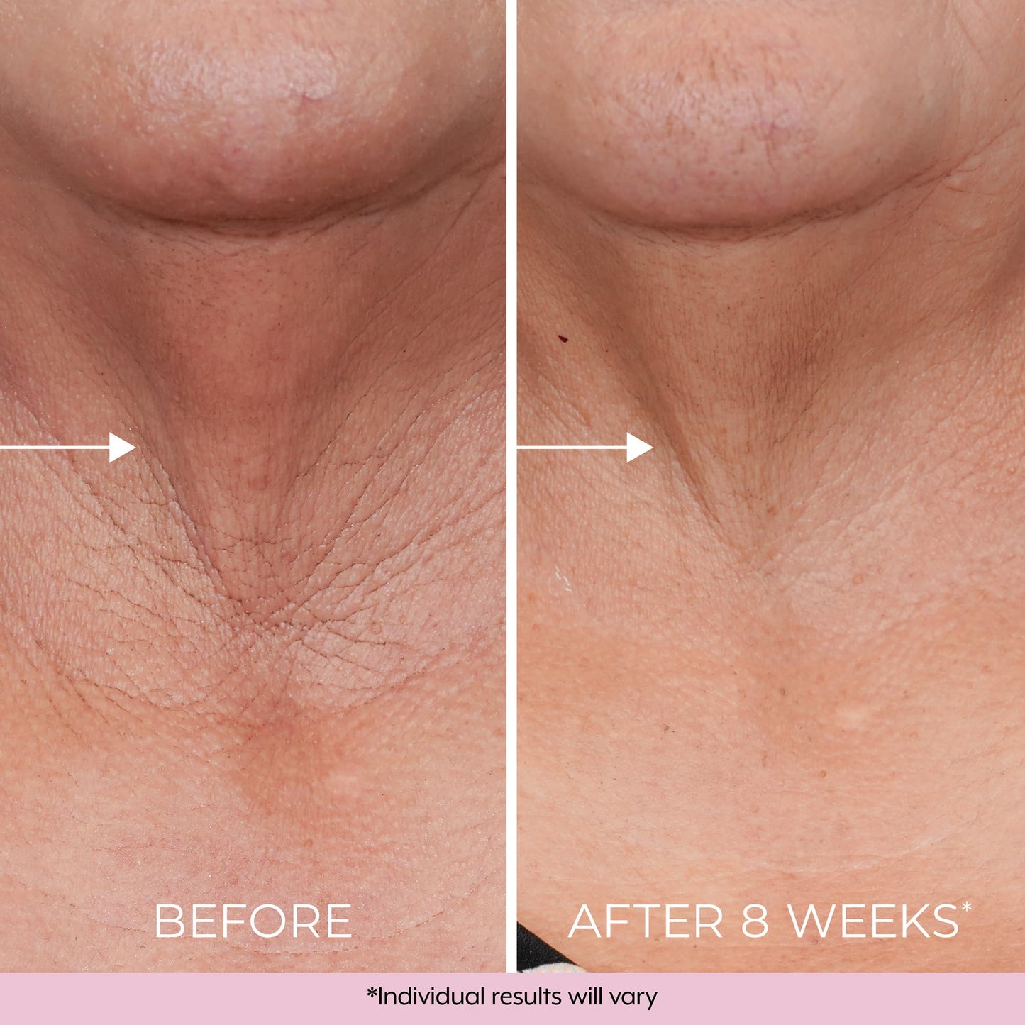 DEKLIDERM Neck Firming Cream – Retinol & Bakuchiol for Neck Lines & Firmness