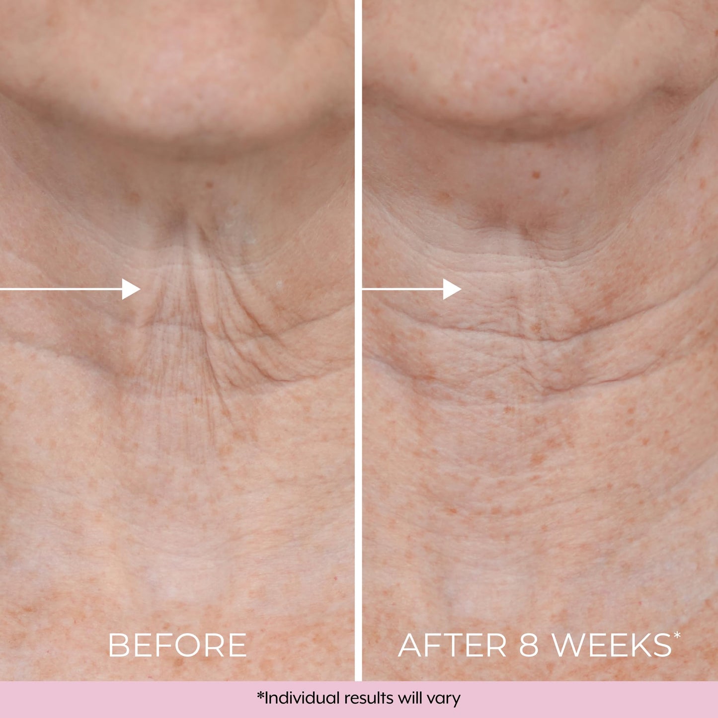 DEKLIDERM Neck Firming Cream – Retinol & Bakuchiol for Neck Lines & Firmness