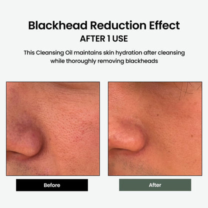 delphyr Liposome Daily Cleansing Oil — Gentle Makeup Remover & Blackhead Care for Sensitive Skin