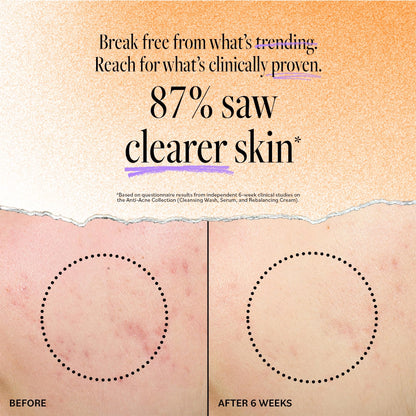 Derma E Acne Deep Pore Cleansing Wash – Salicylic Acid Face Cleanser for Clear Pores | 6 fl oz