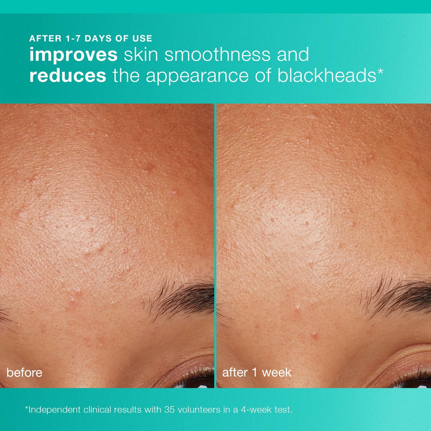 Dermalogica Clear and Brighten Kit – 3 Step Acne & Brightening Skincare Set