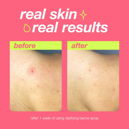 Dermalogica Clear Start Bacne Spray – Back Acne Treatment with Salicylic Acid
