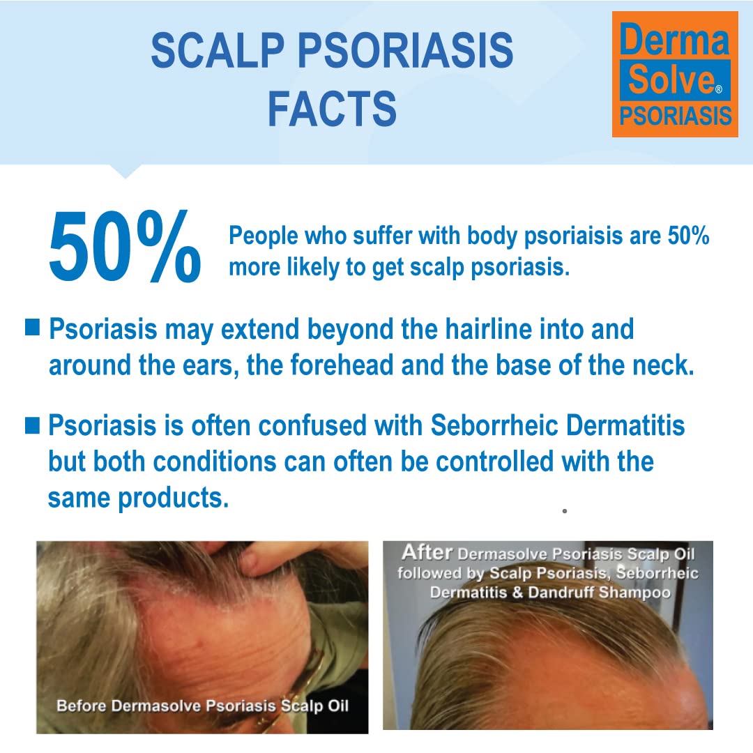 Dermasolve Scalp Psoriasis Medicated Shampoo & Conditioner – 8 oz Bottles (2 Pack) | Soothes Dandruff & Flaky Scalp