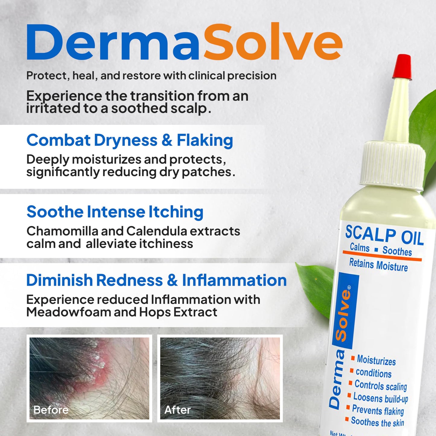 Dermasolve Psoriasis & Dandruff Oil – Dermatologist-Approved Scalp Relief