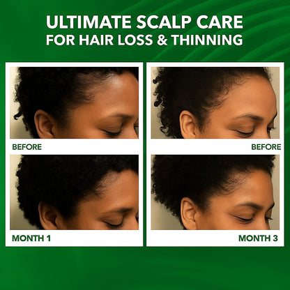 Dersie Scalp Oil for Hair Loss & Thinning Hair – Batana, Rosemary & Tea Tree (60mL)