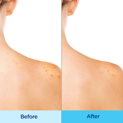 Differin Acne-Clearing Body Spray with Salicylic Acid – 2% SA, 360° Mist, 6 oz