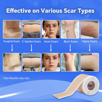 Discoliner Silicone Scar Sheets – Reusable Scar Tape (3M) for Surgical, C-Section, Acne & Burn Scars