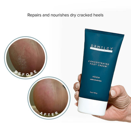 DRMTLGY Concentrated Foot Cream for Dry Cracked Heels | Heel & Foot Lotion