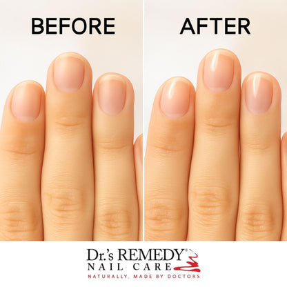 Dr.'s Remedy 4-Pack Nail Polish Treatment Kit | Start To Finish Kit With Radiant Remover, Therapeutic Cuticle Oil & Clarity Coral