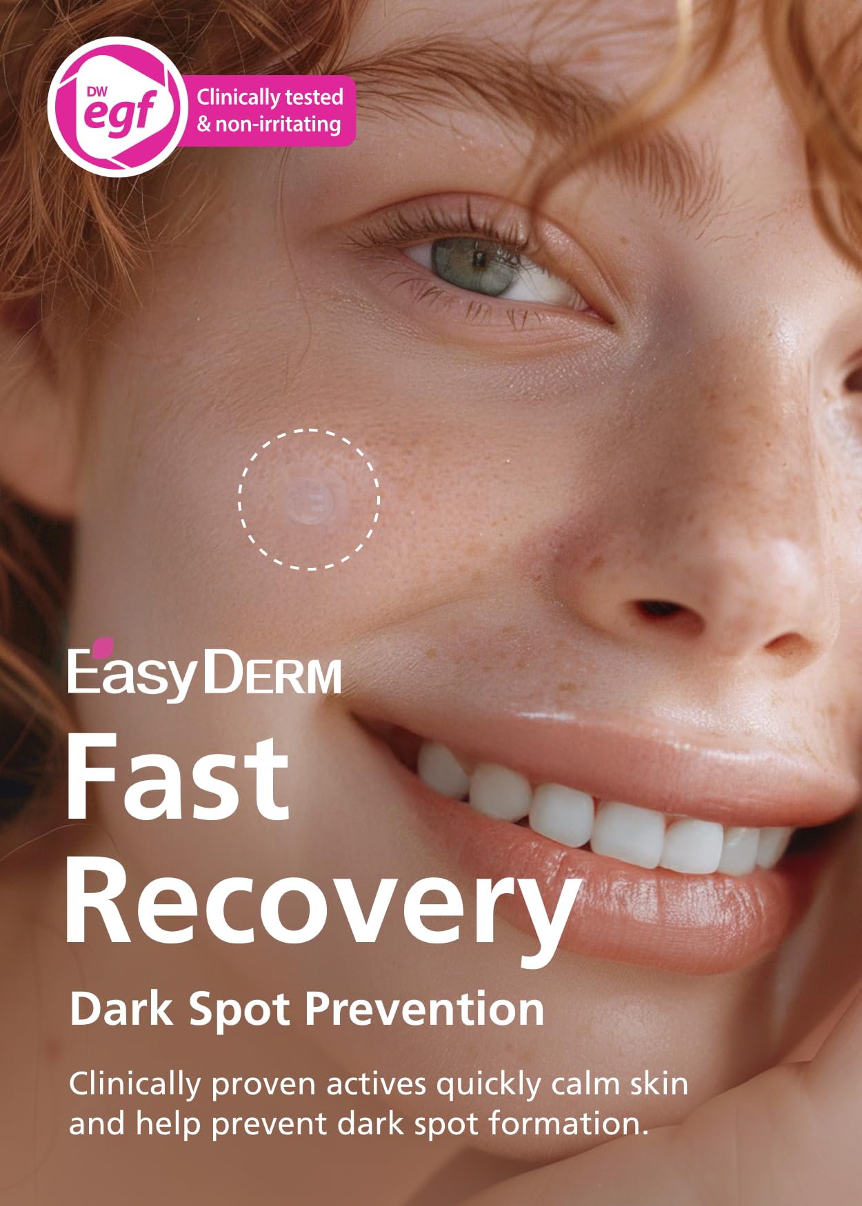 DWEasyDerm Easyderm Real Calming Patch Pimple Patches – Niacinamide, Hyaluronic Acid, EGF | 18 Patches