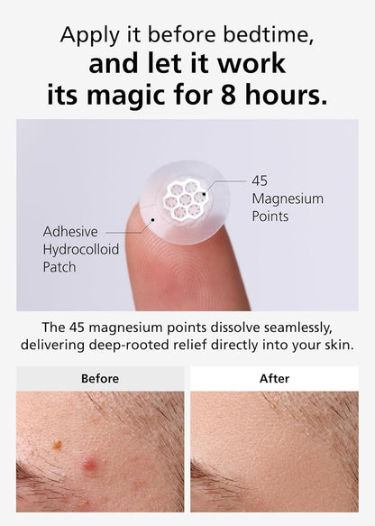 DWEasyDerm EasyDerm Micro Point Acne Patch Duo – 10 Magnesium Patches + 6 Calming Microdart Patches | 2-Step K-Beauty Skincare Kit