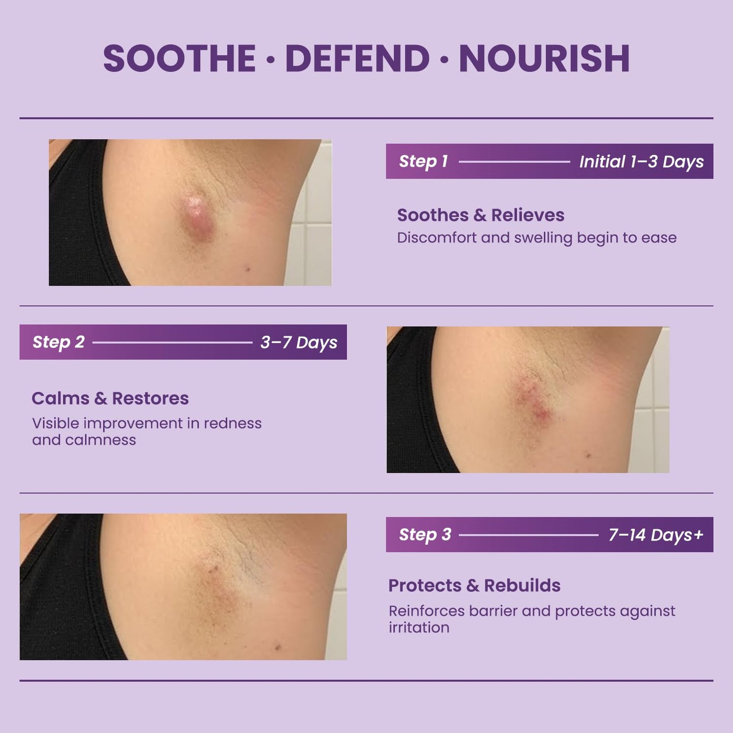 Easment Flare Defense Balm for Hidradenitis Suppurativa – 2 oz | Microsilver BG™ + Zinc Oxide
