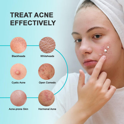 Enaskin Naturals Acne Pimple Spot Treatment Cream – 2% Salicylic Acid for Cystic Breakouts on Face & Back (1.8 oz)