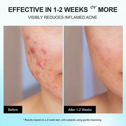 Enaskin Naturals Acne Pimple Spot Treatment Cream – 2% Salicylic Acid for Cystic Breakouts on Face & Back (1.8 oz)