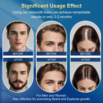 Exdeploy 5% Minoxidil Foam for Men – 5-Pack with Biotin (10.5 oz total)