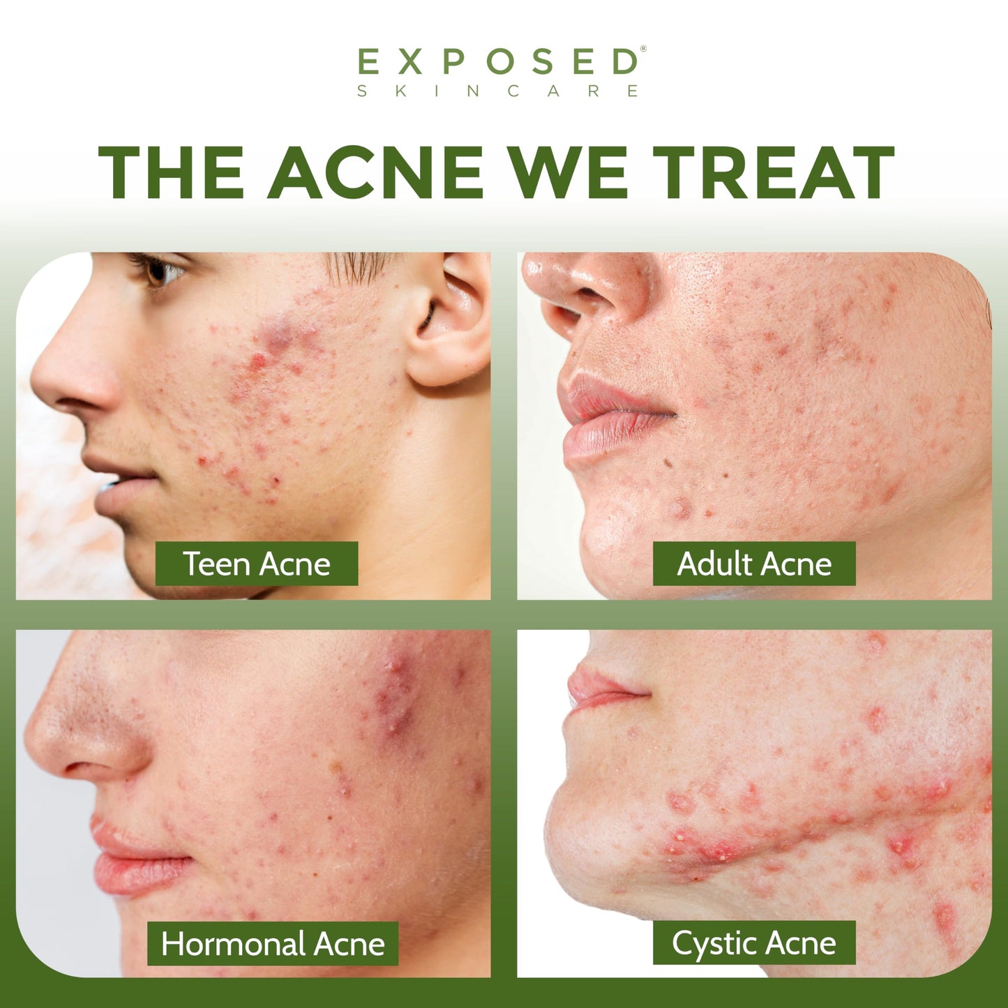 Exposed Skin Care Acne Facial Cleanser with 0.5% Salicylic Acid — Gentle Daily Wash for Sensitive & Acne-Prone Skin