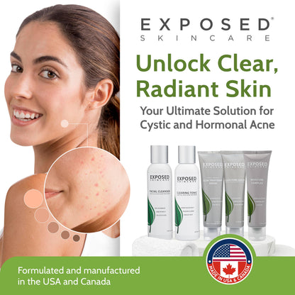 Exposed Skin Care Expanded Acne Treatment Kit – 2.5% Salicylic Acid & 3.5% Benzoyl Peroxide