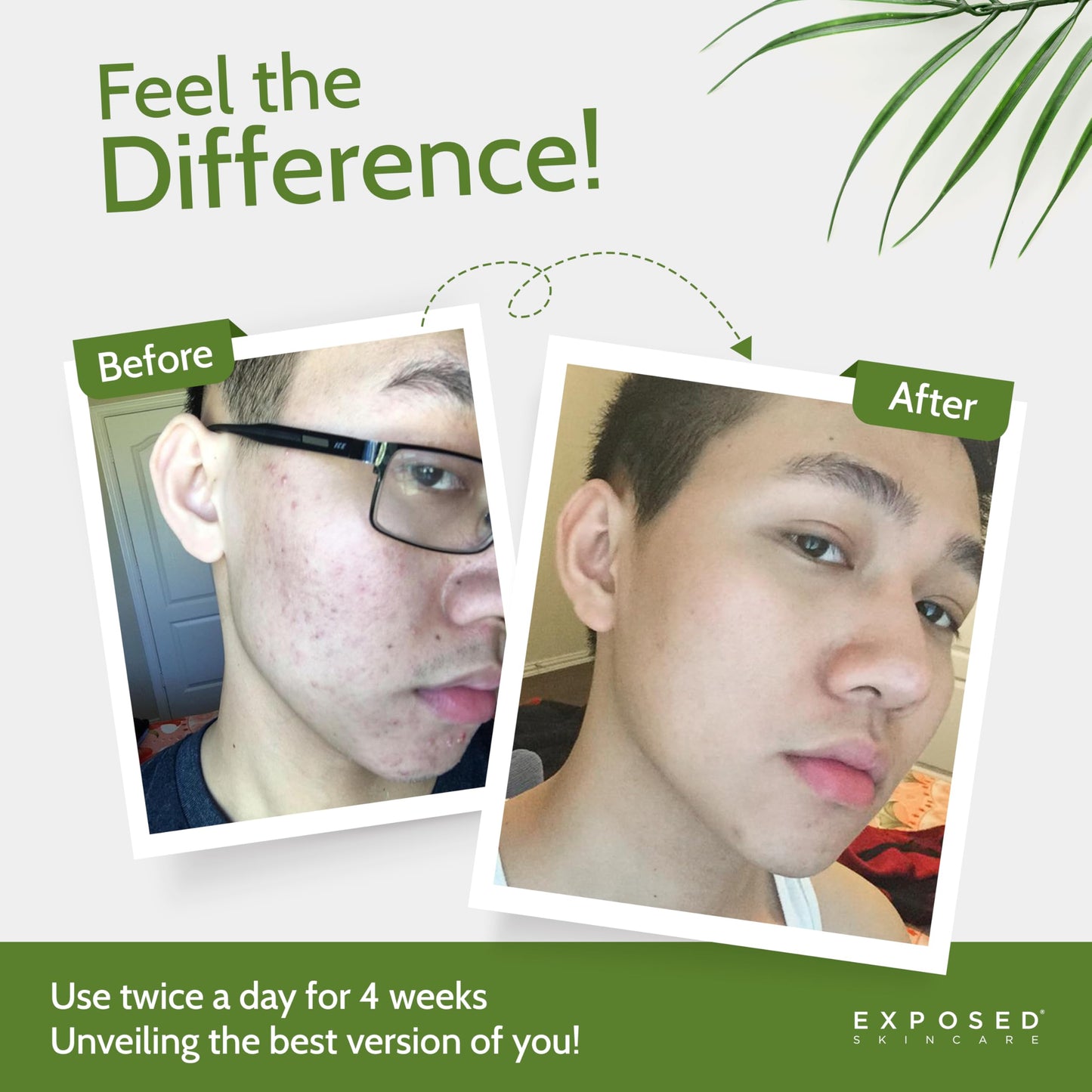 Exposed Skin Care Moisture Complex: Oil-Free Daily Face Moisturizer for Oily, Acne-Prone Skin