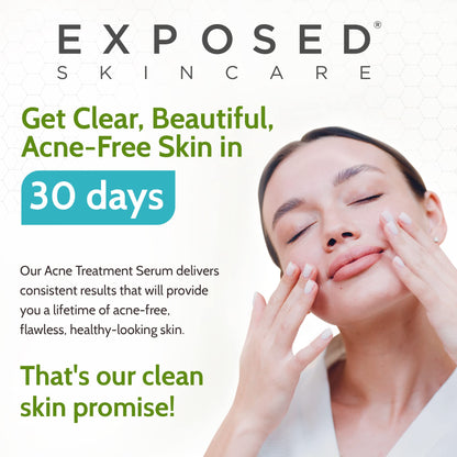 Exposed Skin Care Acne Treatment Serum with 3.5% Benzoyl Peroxide – Lightweight Spot Treatment for Teens, Adults, Hormonal & Cystic Acne – Cruelty Free